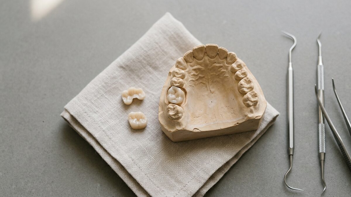 Dental crown vs onlay: when each restoration makes sense